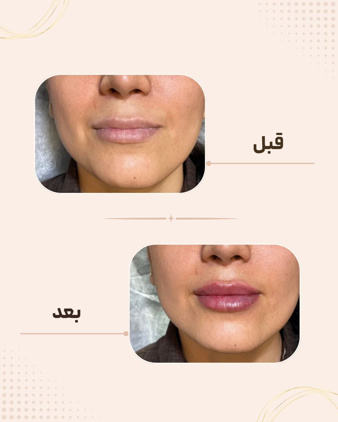 نمونه نتیجه قبل و بعد فیلر لب در کلینیک زیبایی روناش سقز – شماره 10