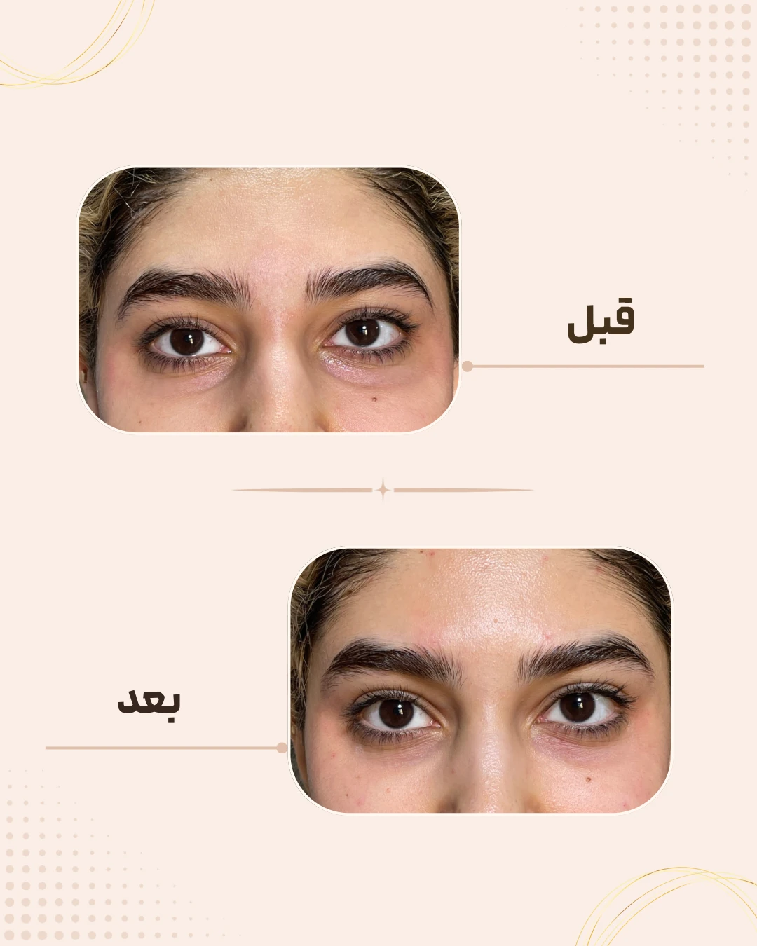 نمونه نتیجه قبل و بعد فیلر زیر چشم در کلینیک زیبایی روناش سقز – شماره 2