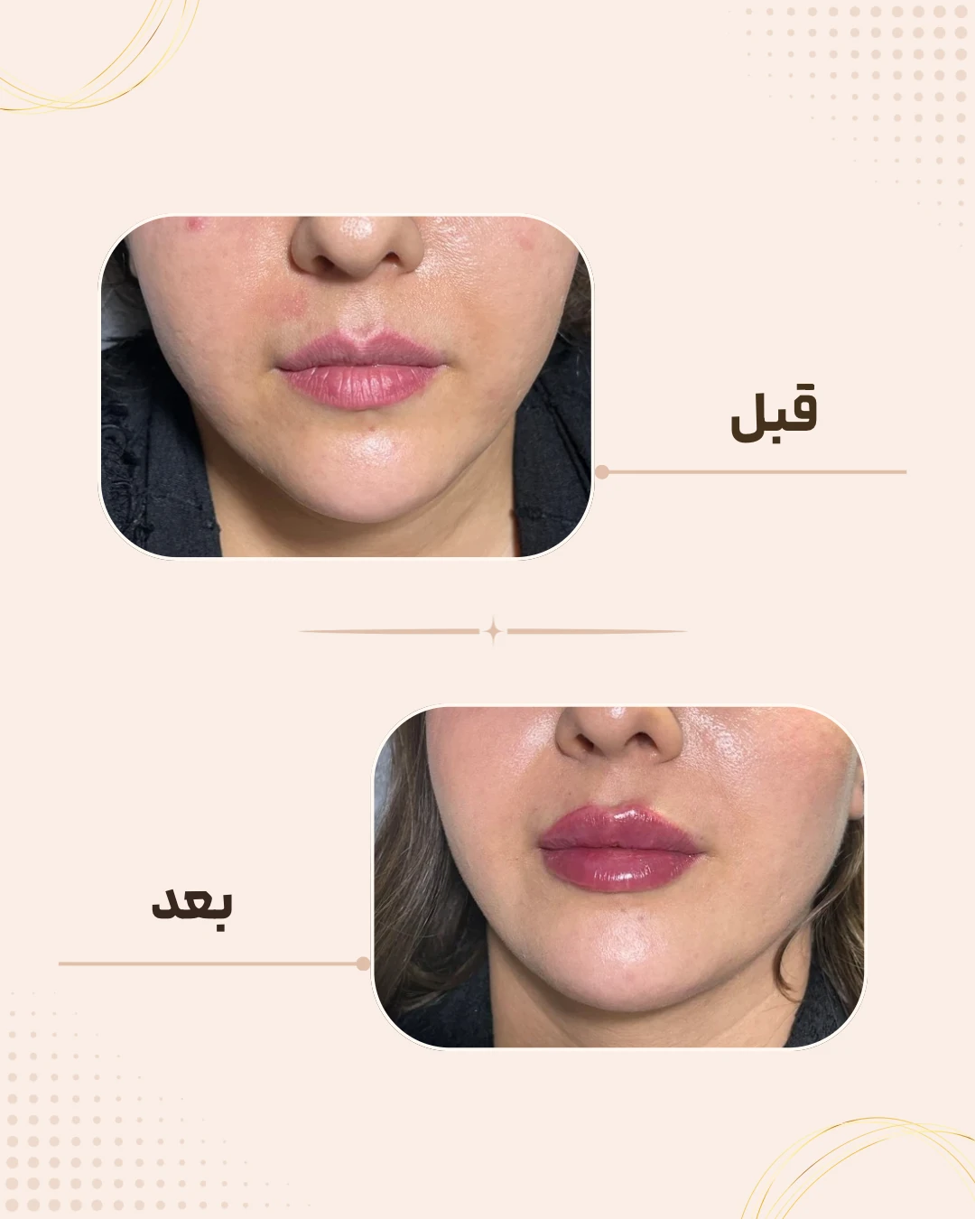 نمونه نتیجه قبل و بعد فیلر لب در کلینیک زیبایی روناش سقز – شماره 12