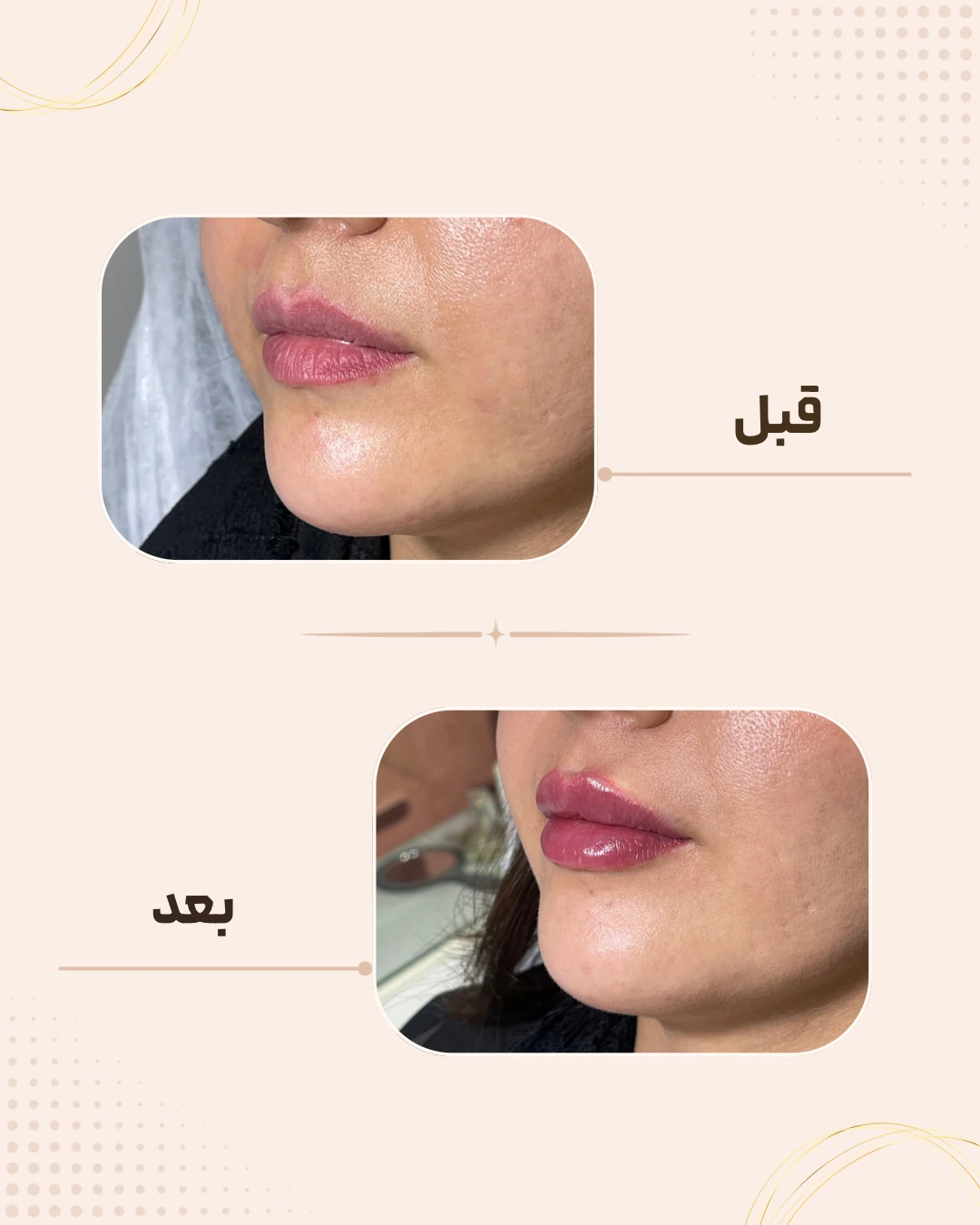 نمونه نتیجه قبل و بعد فیلر لب در کلینیک زیبایی روناش سقز – شماره 13