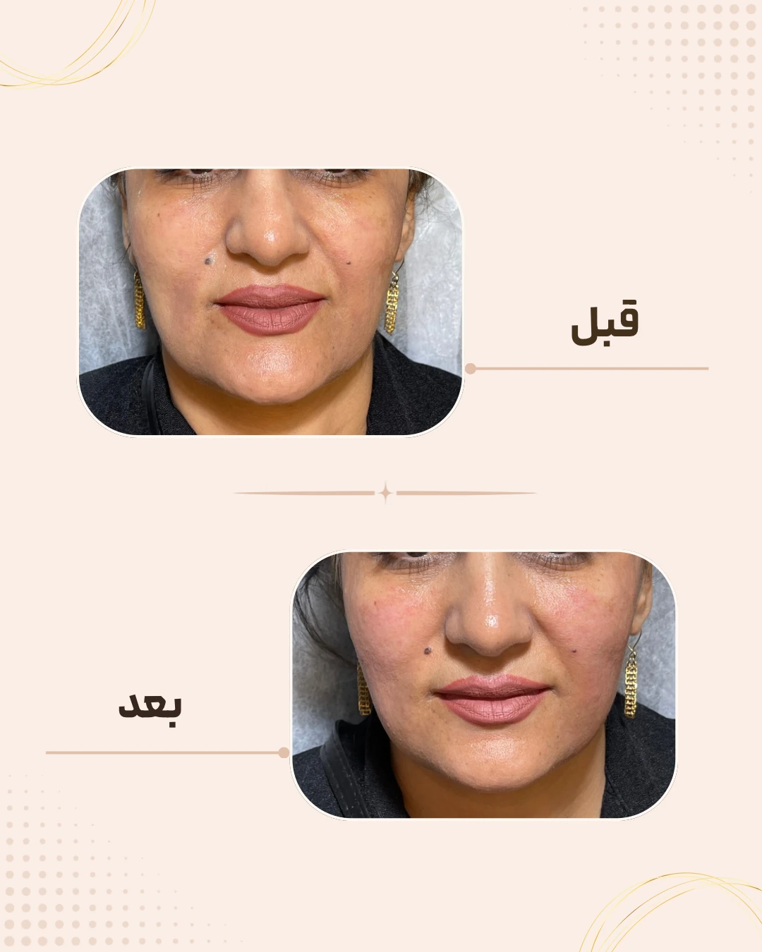 نمونه نتیجه قبل و بعد فیلر گونه در کلینیک زیبایی روناش سقز – شماره 3