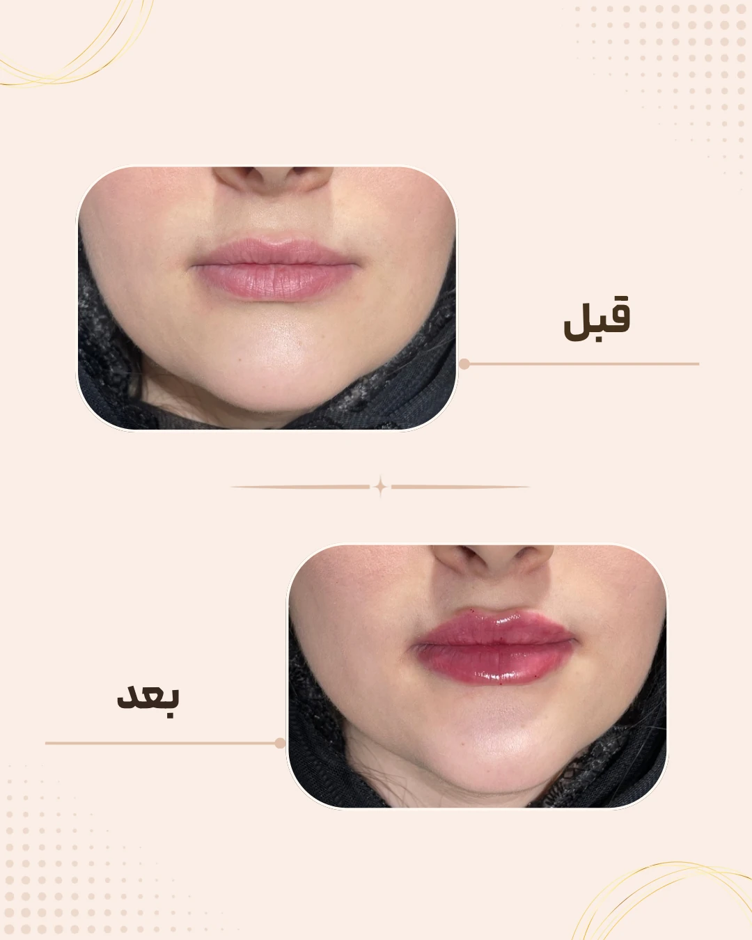 نمونه نتیجه قبل و بعد فیلر لب در کلینیک زیبایی روناش سقز – شماره 1