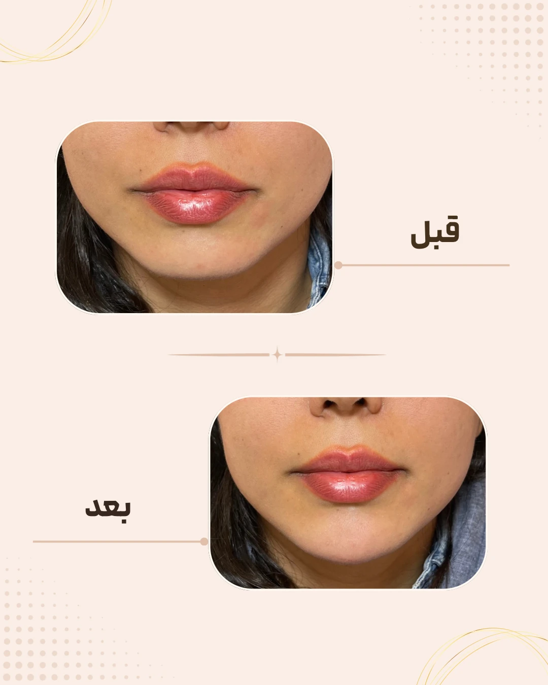 نمونه نتیجه قبل و بعد چانه و زاویه فک در کلینیک زیبایی روناش سقز – شماره 6