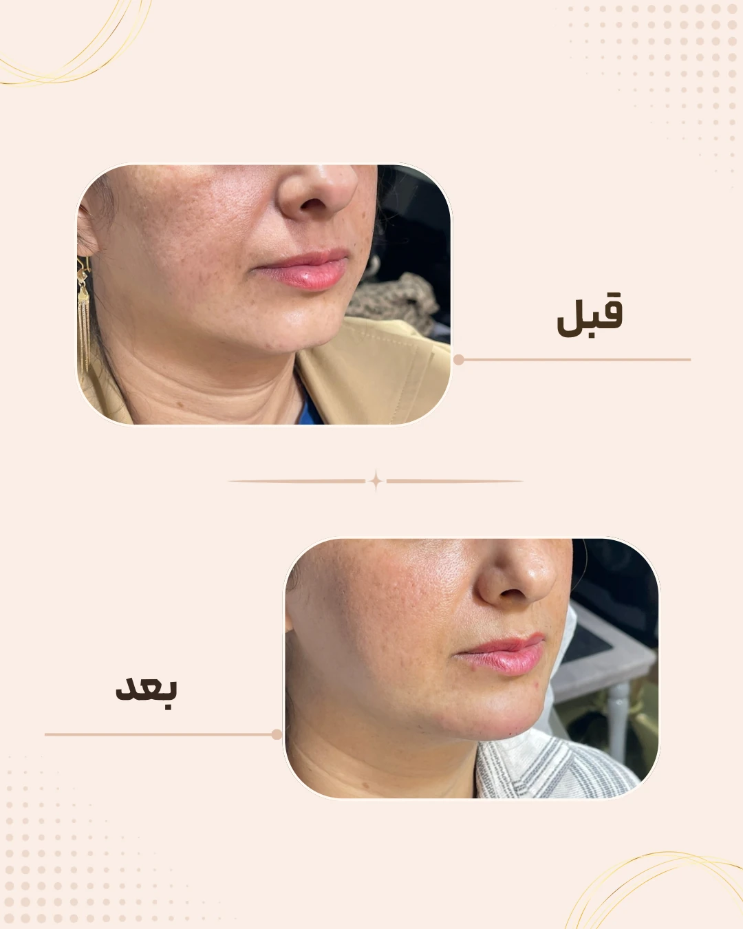 نمونه نتیجه قبل و بعد چانه و زاویه فک در کلینیک زیبایی روناش سقز – شماره 1