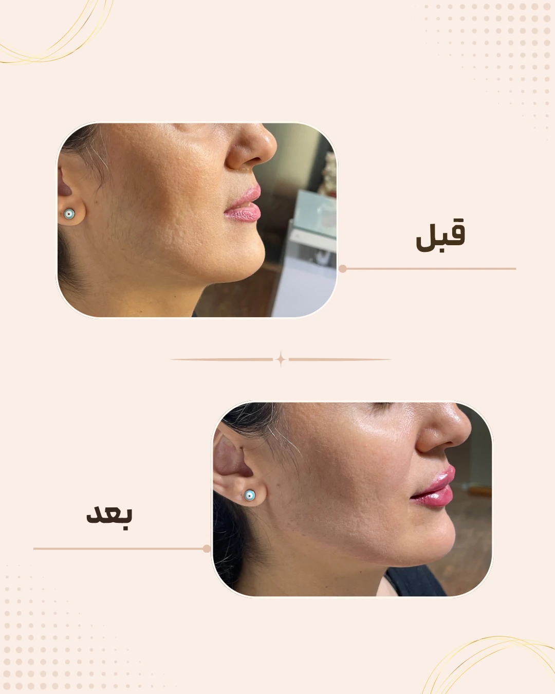 نمونه نتیجه قبل و بعد چانه و زاویه فک در کلینیک زیبایی روناش سقز – شماره 2