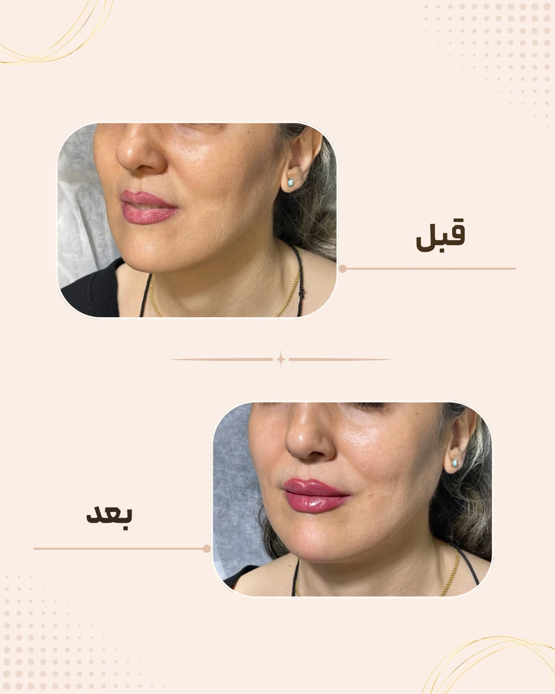 نمونه نتیجه قبل و بعد فیلر لب در کلینیک زیبایی روناش سقز – شماره 4