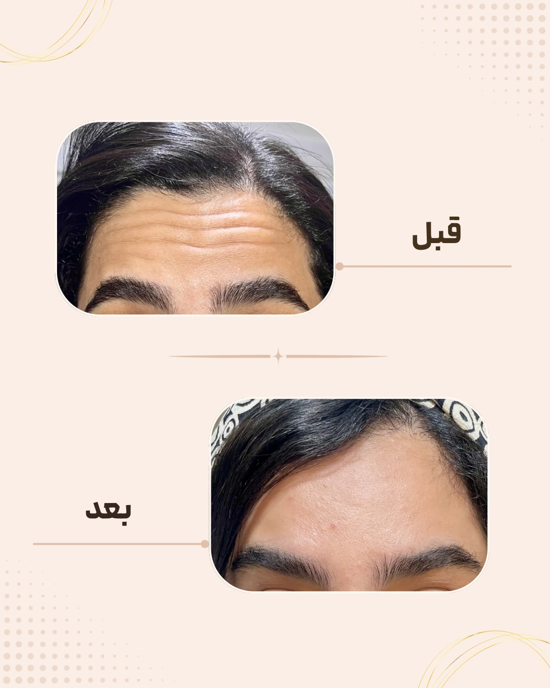 نمونه نتیجه قبل و بعد بوتاکس در کلینیک زیبایی روناش سقز – شماره 8