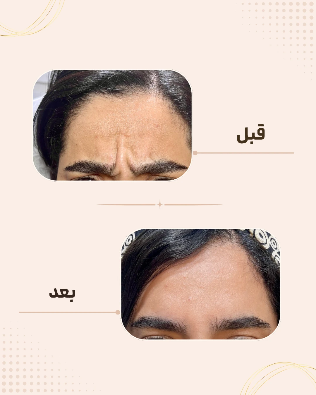 نمونه نتیجه قبل و بعد بوتاکس در کلینیک زیبایی روناش سقز – شماره 9