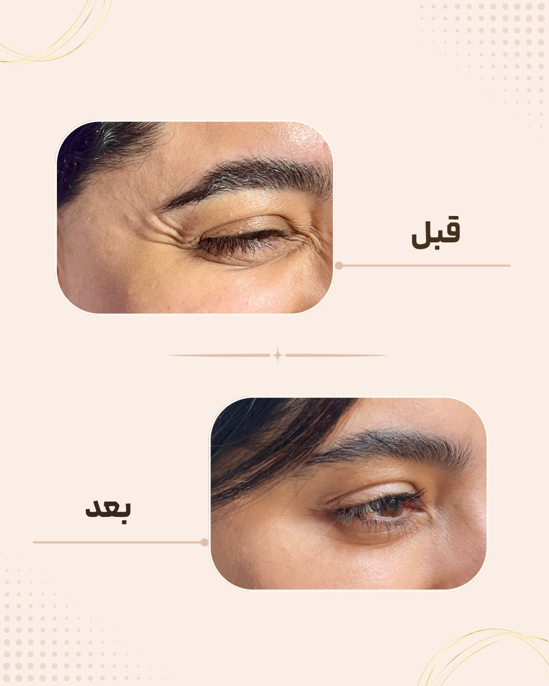 نمونه نتیجه قبل و بعد بوتاکس در کلینیک زیبایی روناش سقز – شماره 1
