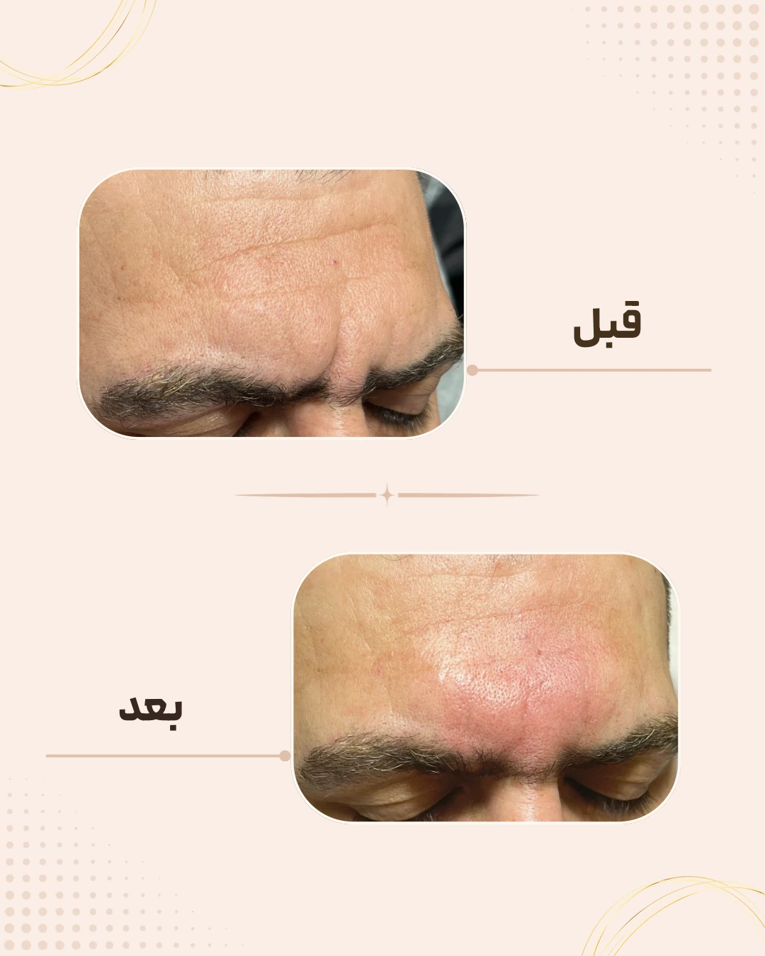 نمونه نتیجه قبل و بعد فیلر خط اخم در کلینیک زیبایی روناش سقز – شماره 1