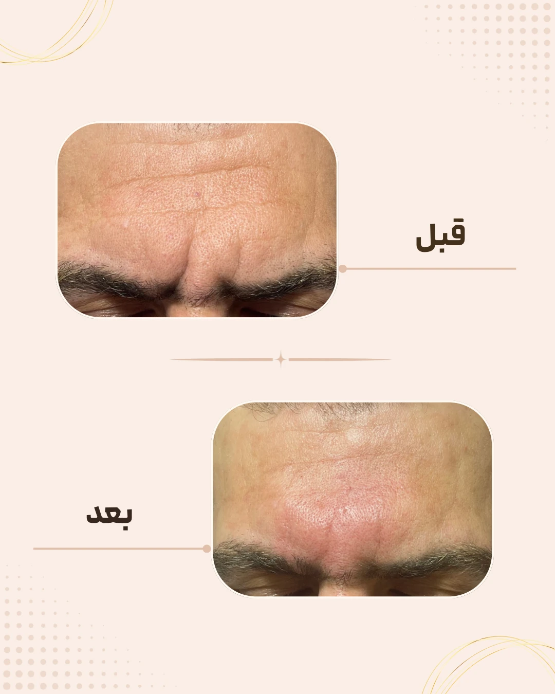 نمونه نتیجه قبل و بعد فیلر خط اخم در کلینیک زیبایی روناش سقز – شماره 2