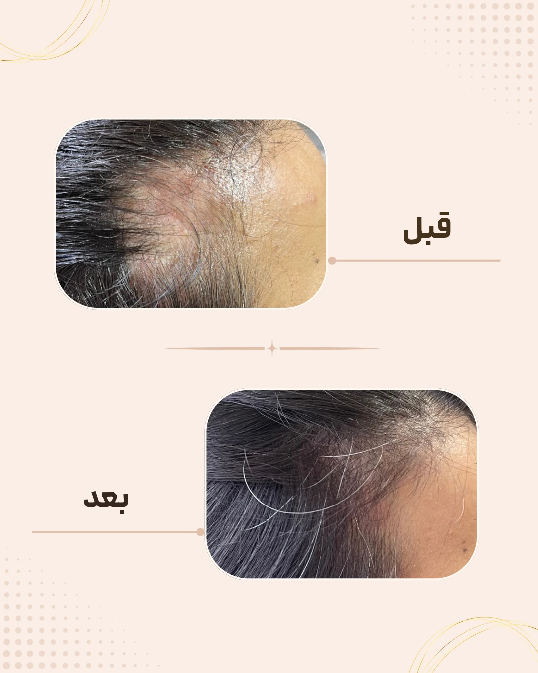 نمونه نتیجه قبل و بعد مزوتراپی مو در کلینیک زیبایی روناش سقز – شماره 1