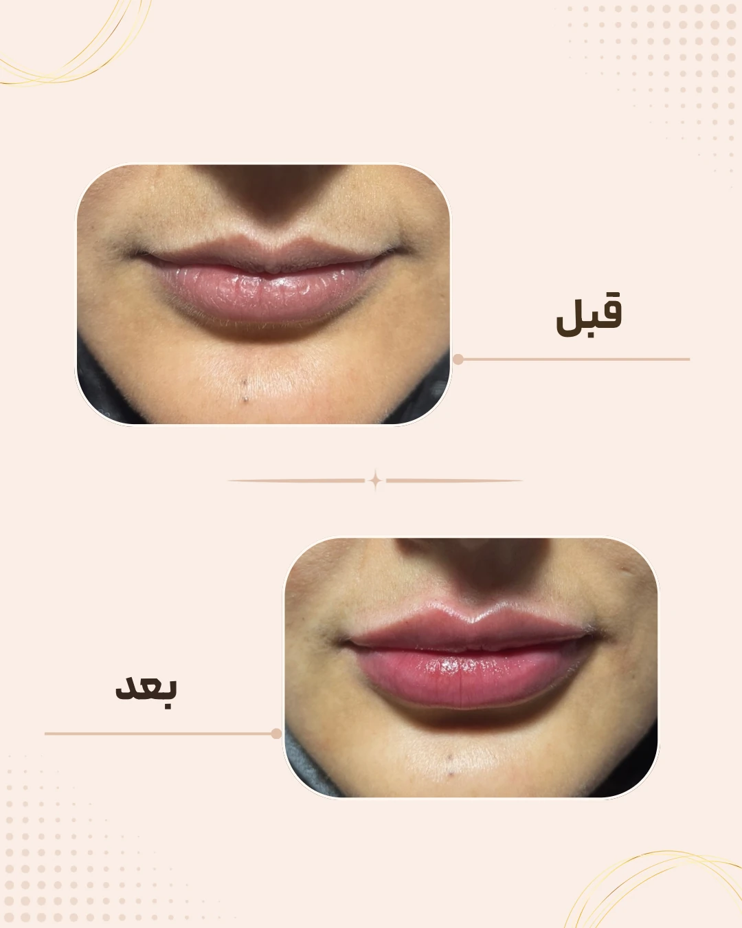 نمونه نتیجه قبل و بعد فیلر لب در کلینیک زیبایی روناش سقز – شماره 5