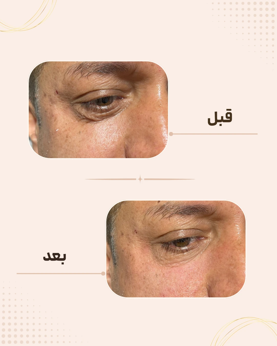 نمونه نتیجه قبل و بعد فیلر زیر چشم در کلینیک زیبایی روناش سقز – شماره 6