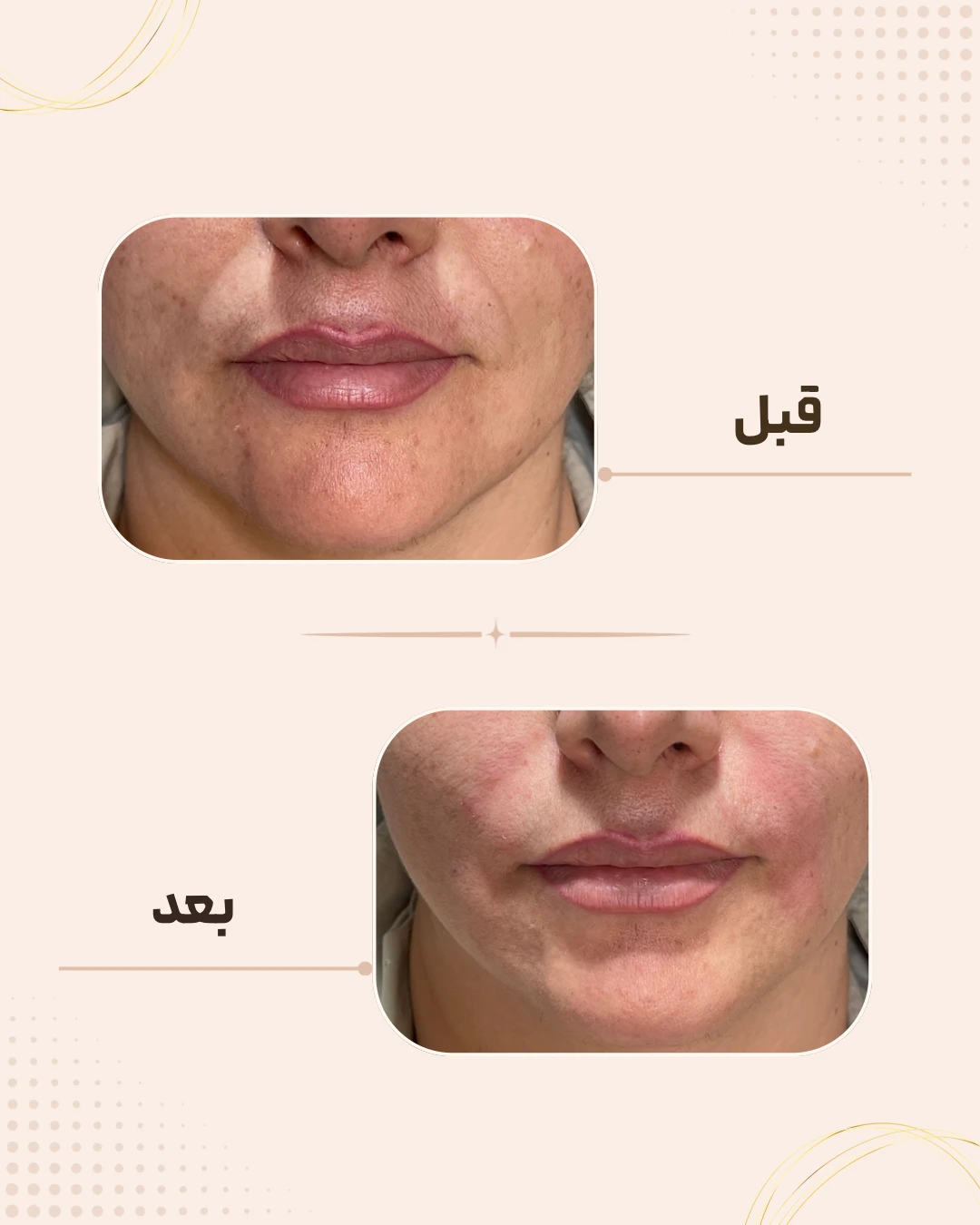 نمونه نتیجه قبل و بعد فیلر خط خنده در کلینیک زیبایی روناش سقز – شماره 4