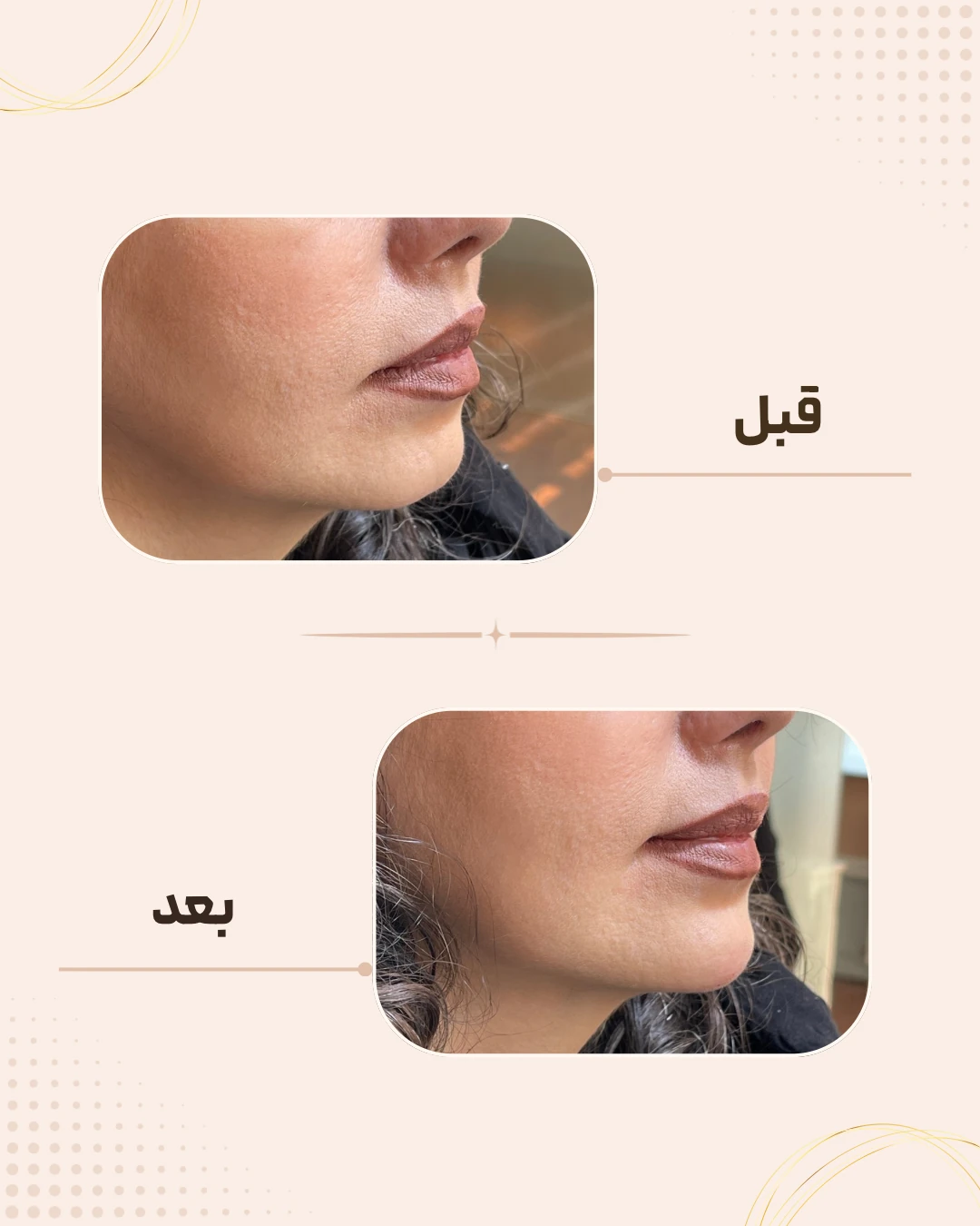 نمونه نتیجه قبل و بعد چانه و زاویه فک در کلینیک زیبایی روناش سقز – شماره 3