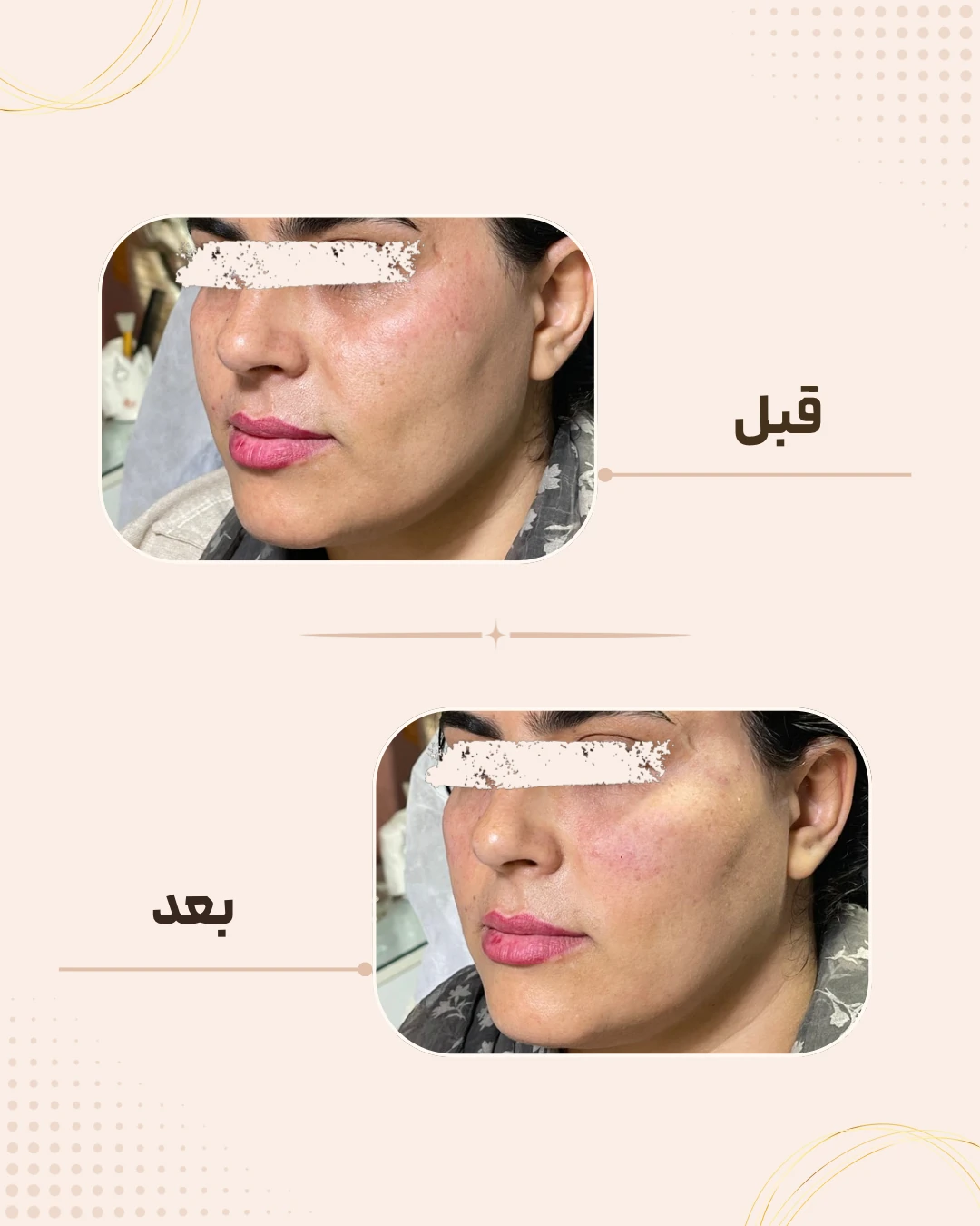 نمونه نتیجه قبل و بعد فیلر گونه در کلینیک زیبایی روناش سقز – شماره 2