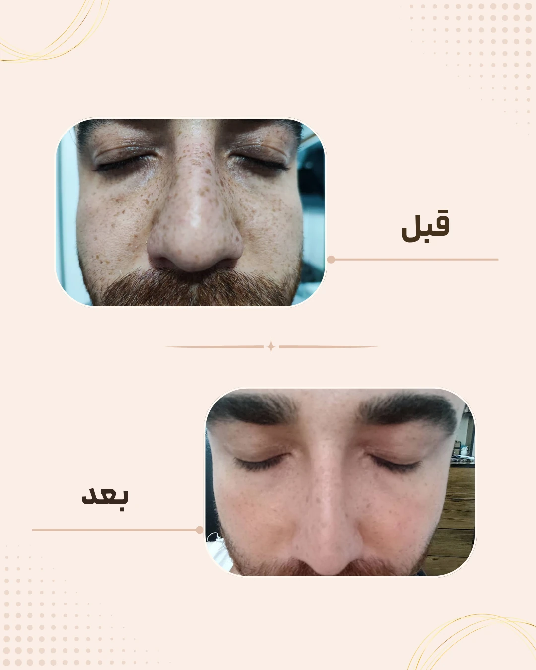 نمونه نتیجه قبل و بعد فیشال در کلینیک زیبایی روناش سقز – شماره 1