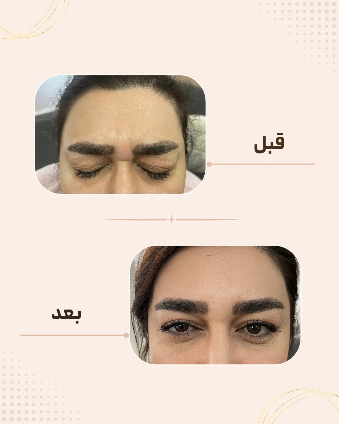 نمونه نتیجه قبل و بعد بوتاکس در کلینیک زیبایی روناش سقز – شماره 5