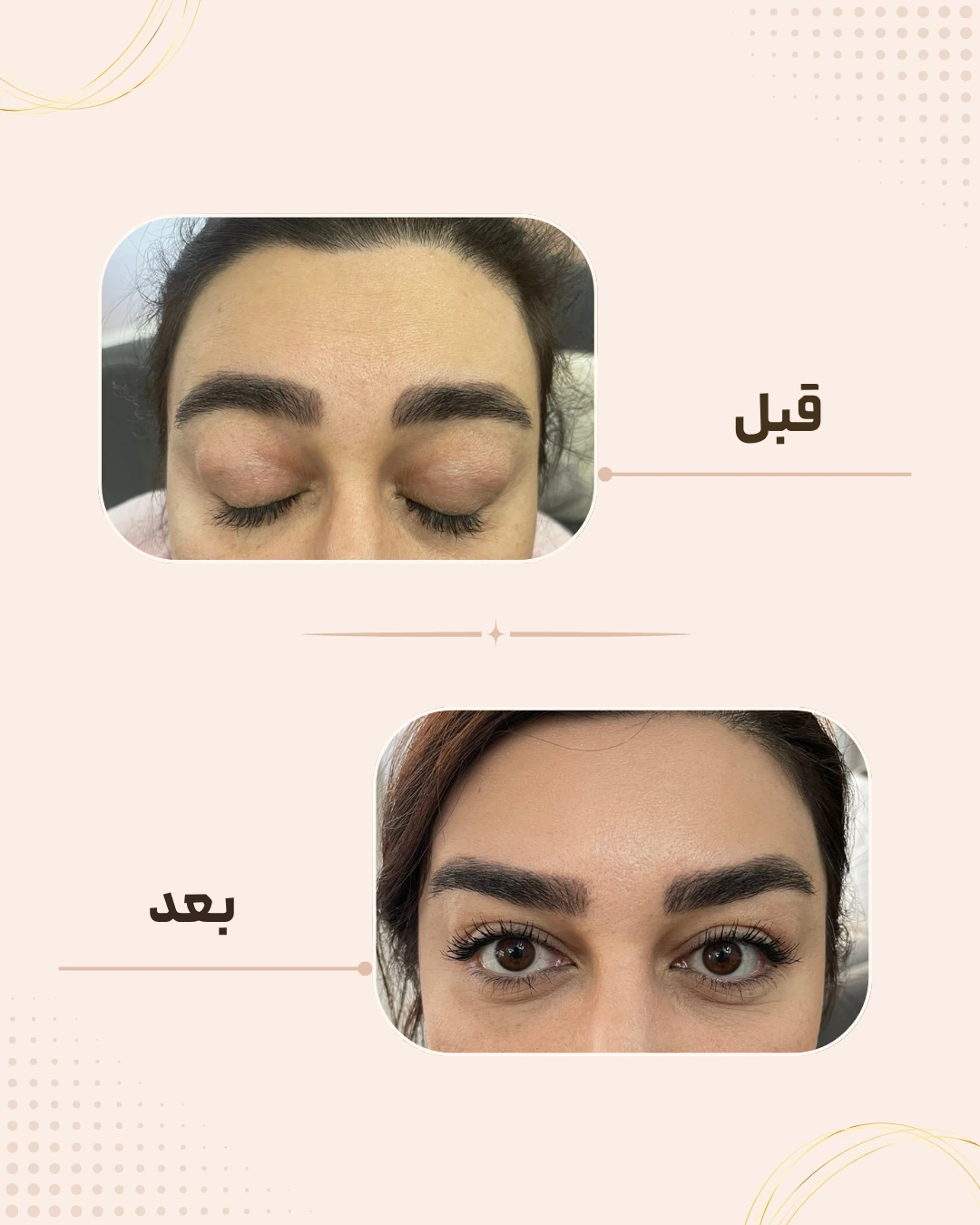 نمونه نتیجه قبل و بعد بوتاکس در کلینیک زیبایی روناش سقز – شماره 6