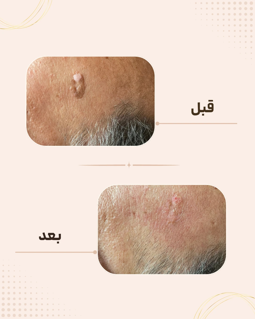 نمونه نتیجه قبل و بعد درمان‌های دستگاهی در کلینیک زیبایی روناش سقز – شماره 8