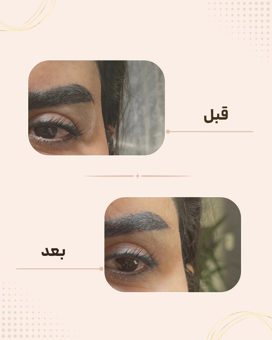 نمونه نتیجه قبل و بعد فیلر شقیقه در کلینیک زیبایی روناش سقز – شماره 1