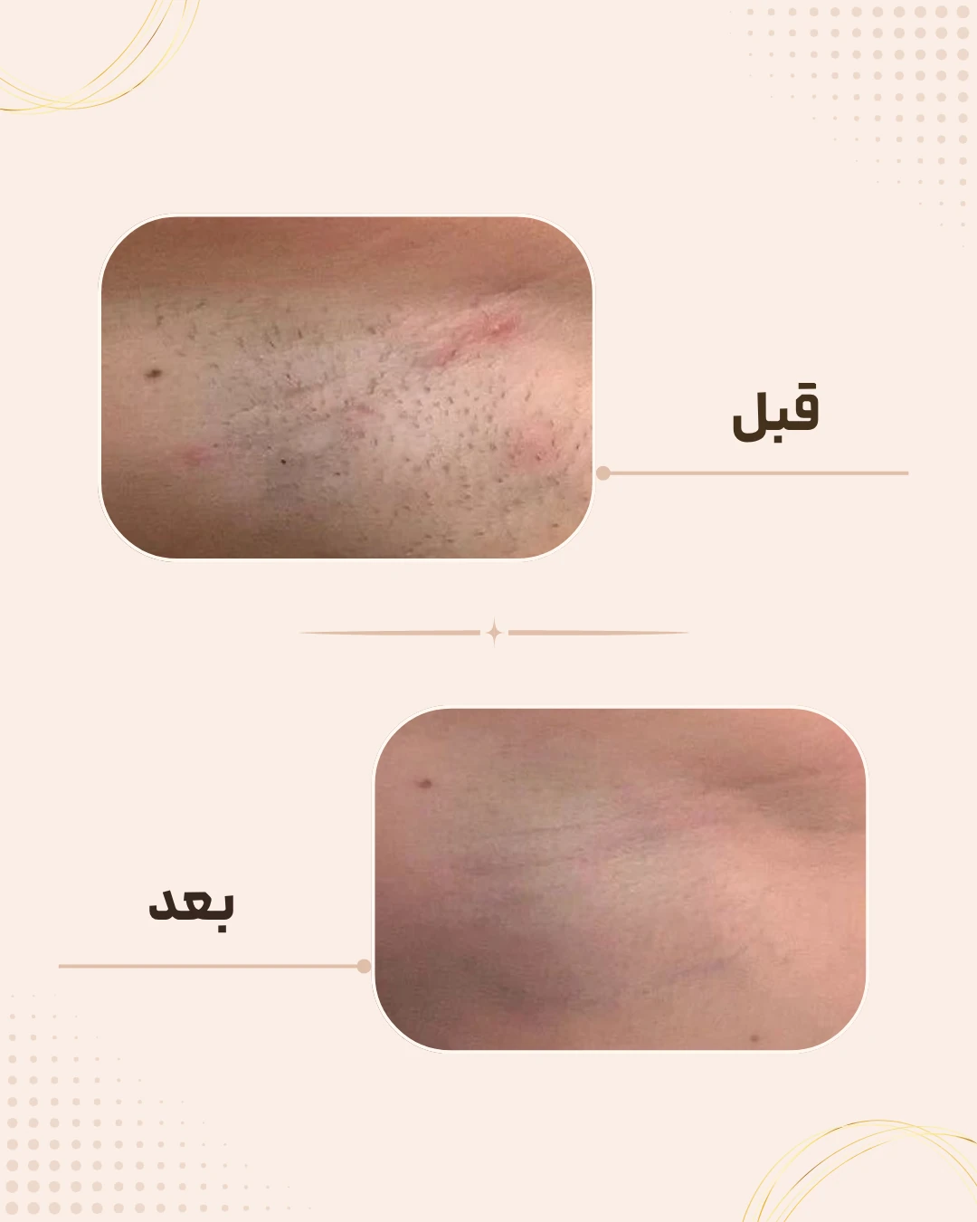 نمونه نتیجه قبل و بعد لیزر موهای زائد در کلینیک زیبایی روناش سقز – شماره 1