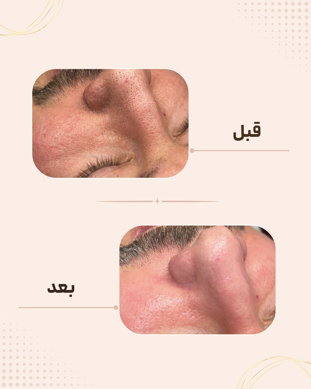 نمونه نتیجه قبل و بعد فیشال در کلینیک زیبایی روناش سقز – شماره 2