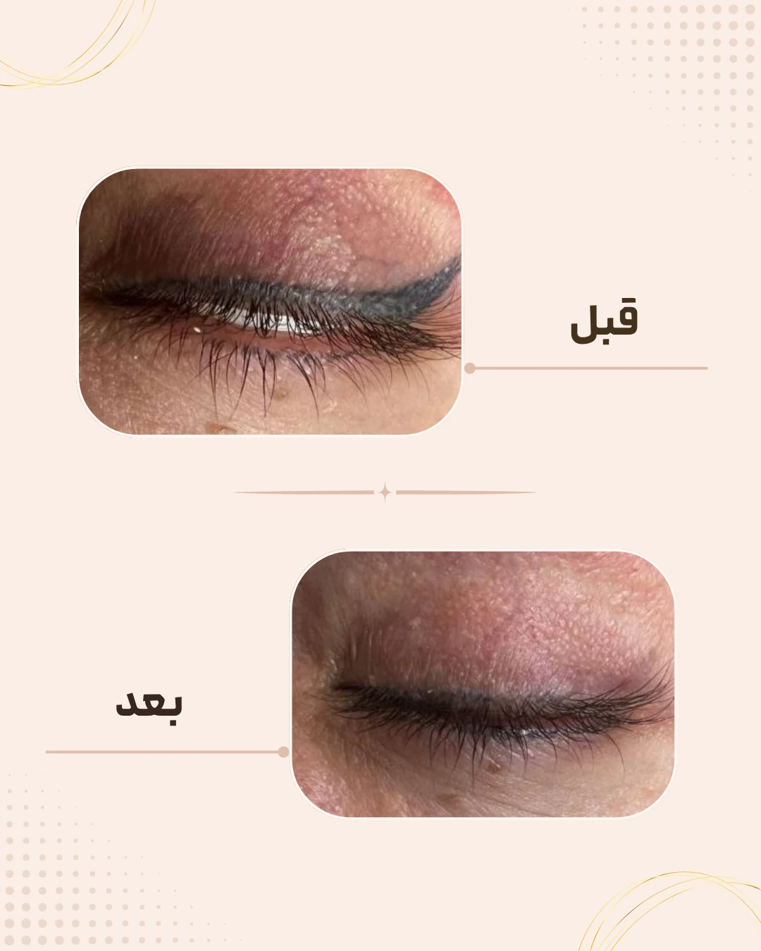 نمونه نتیجه قبل و بعد درمان‌های دستگاهی در کلینیک زیبایی روناش سقز – شماره 3
