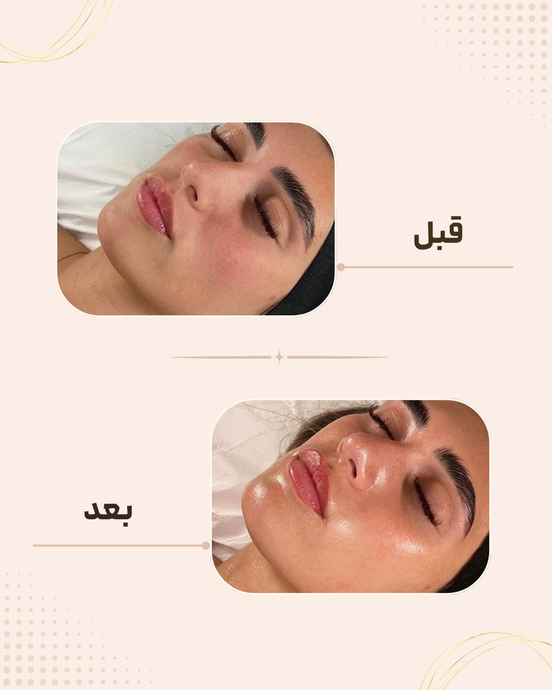نمونه نتیجه قبل و بعد فیشال در کلینیک زیبایی روناش سقز – شماره 3