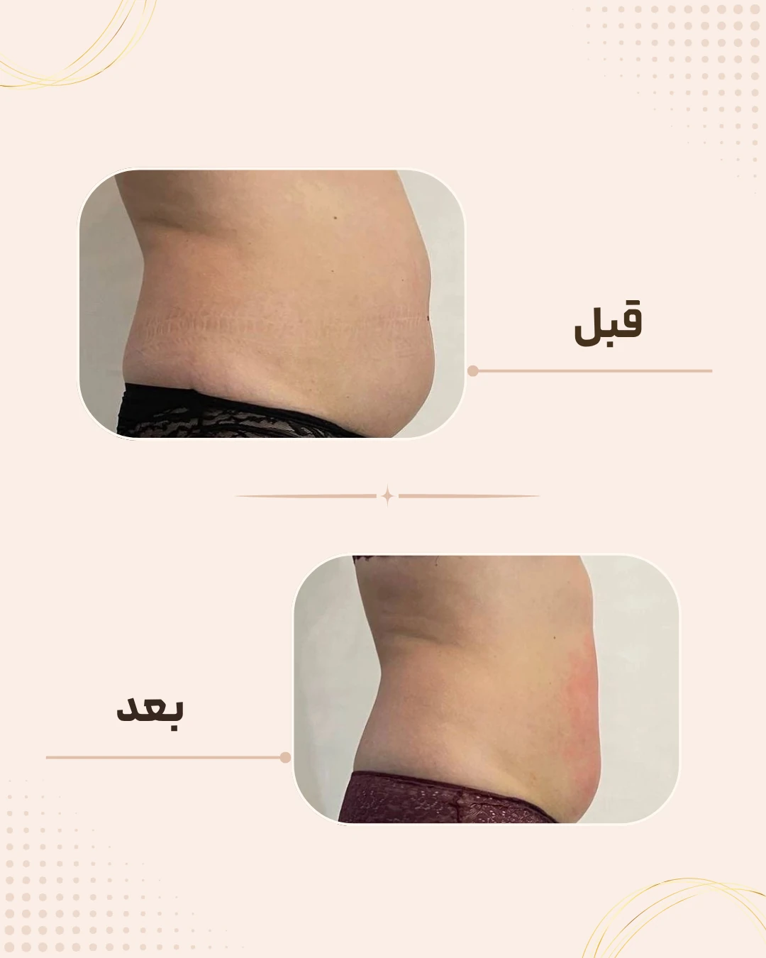 نمونه نتیجه قبل و بعد فرم‌دهی بدن در کلینیک زیبایی روناش سقز – شماره 1
