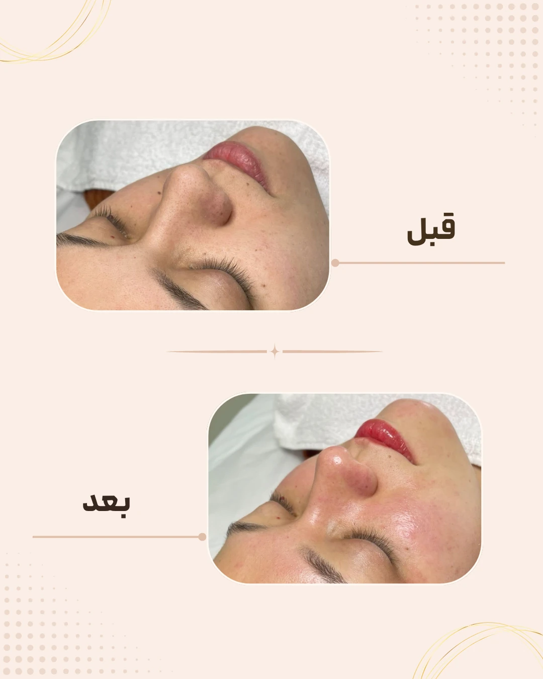 نمونه نتیجه قبل و بعد فیشال در کلینیک زیبایی روناش سقز – شماره 4