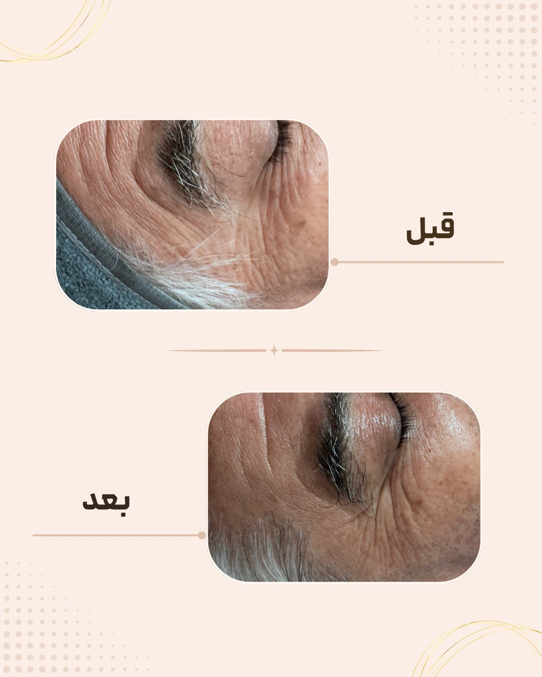 نمونه نتیجه قبل و بعد فیشال در کلینیک زیبایی روناش سقز – شماره 5