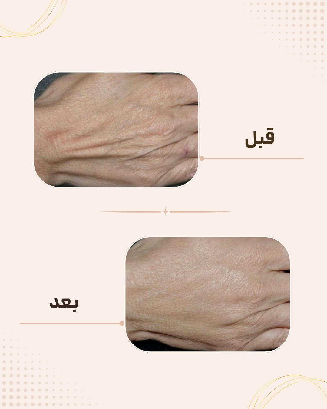 نمونه نتیجه قبل و بعد جوان‌سازی پوست در کلینیک زیبایی روناش سقز – شماره 1