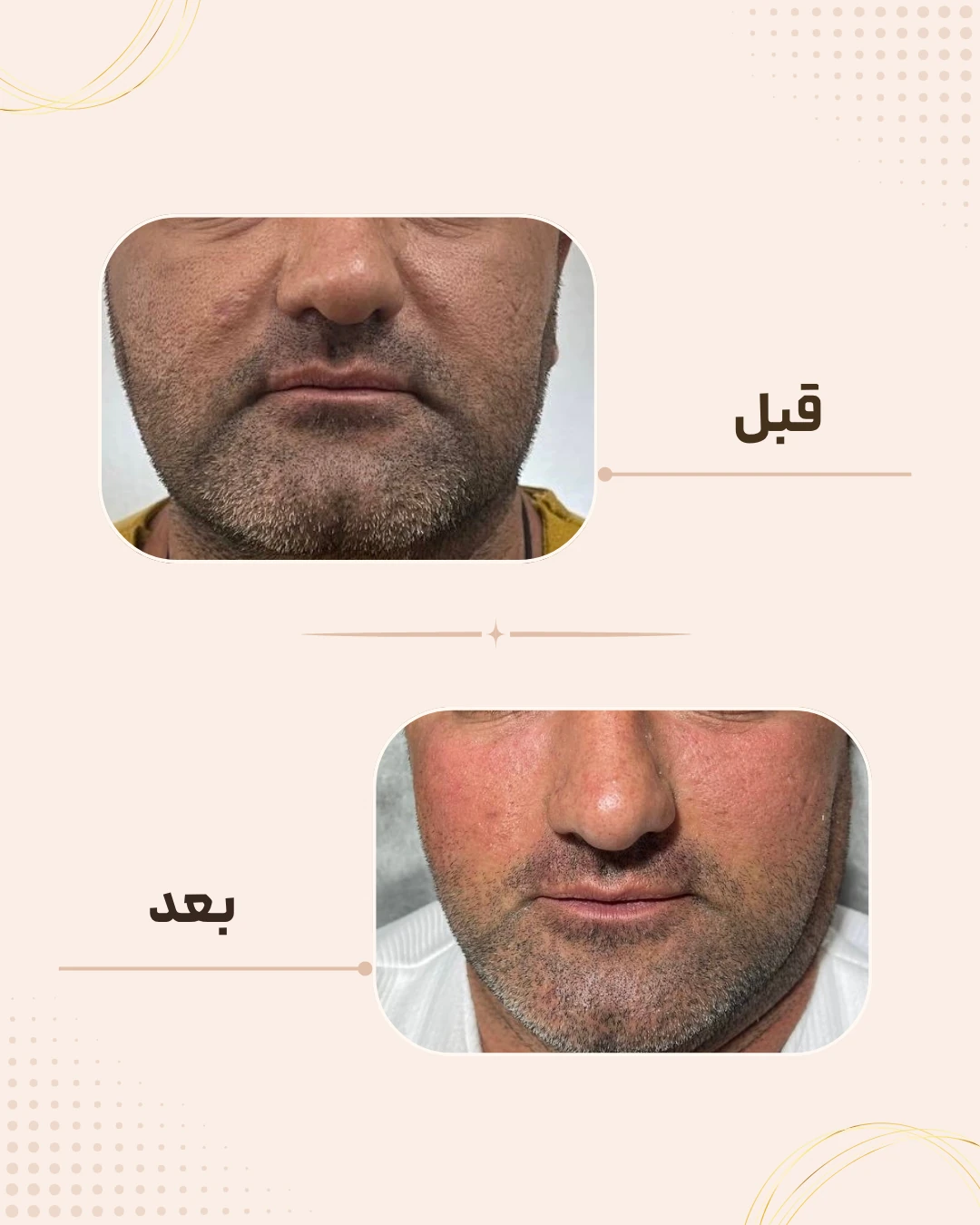 نمونه نتیجه قبل و بعد فیلر زیر چشم در کلینیک زیبایی روناش سقز – شماره 5