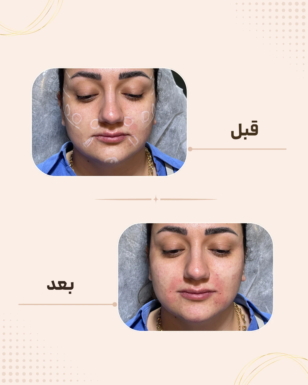 نمونه نتیجه قبل و بعد جوان‌سازی پوست در کلینیک زیبایی روناش سقز – شماره 2
