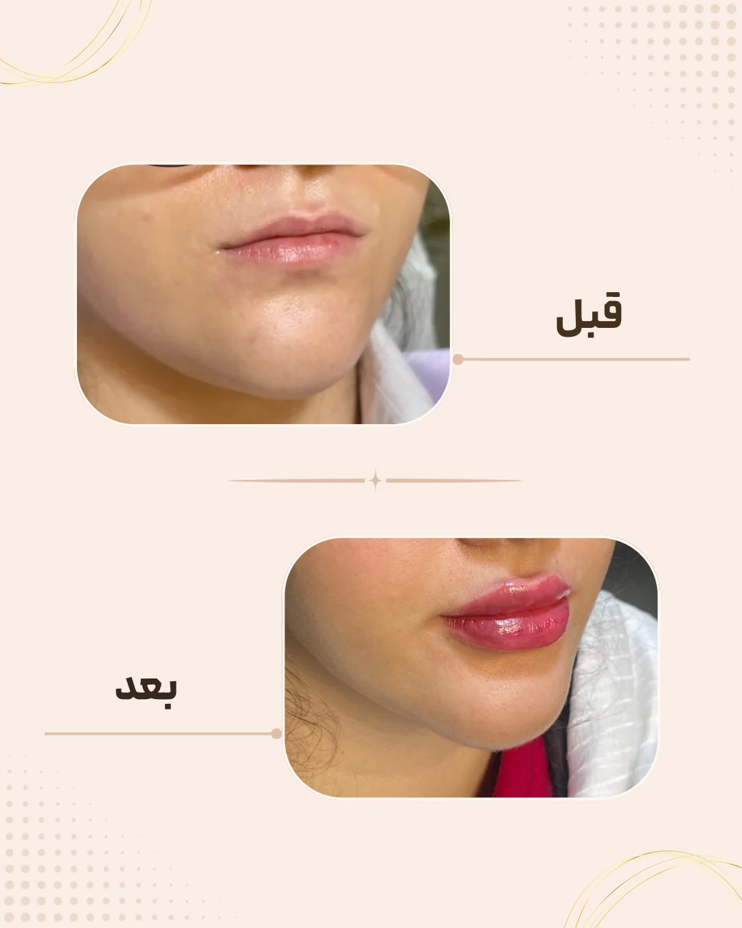 نمونه نتیجه قبل و بعد فیلر لب در کلینیک زیبایی روناش سقز – شماره 6