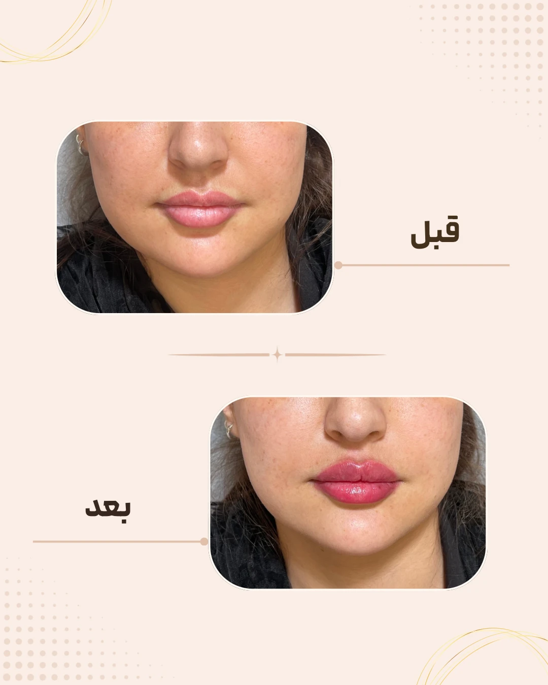 نمونه نتیجه قبل و بعد فیلر لب در کلینیک زیبایی روناش سقز – شماره 7