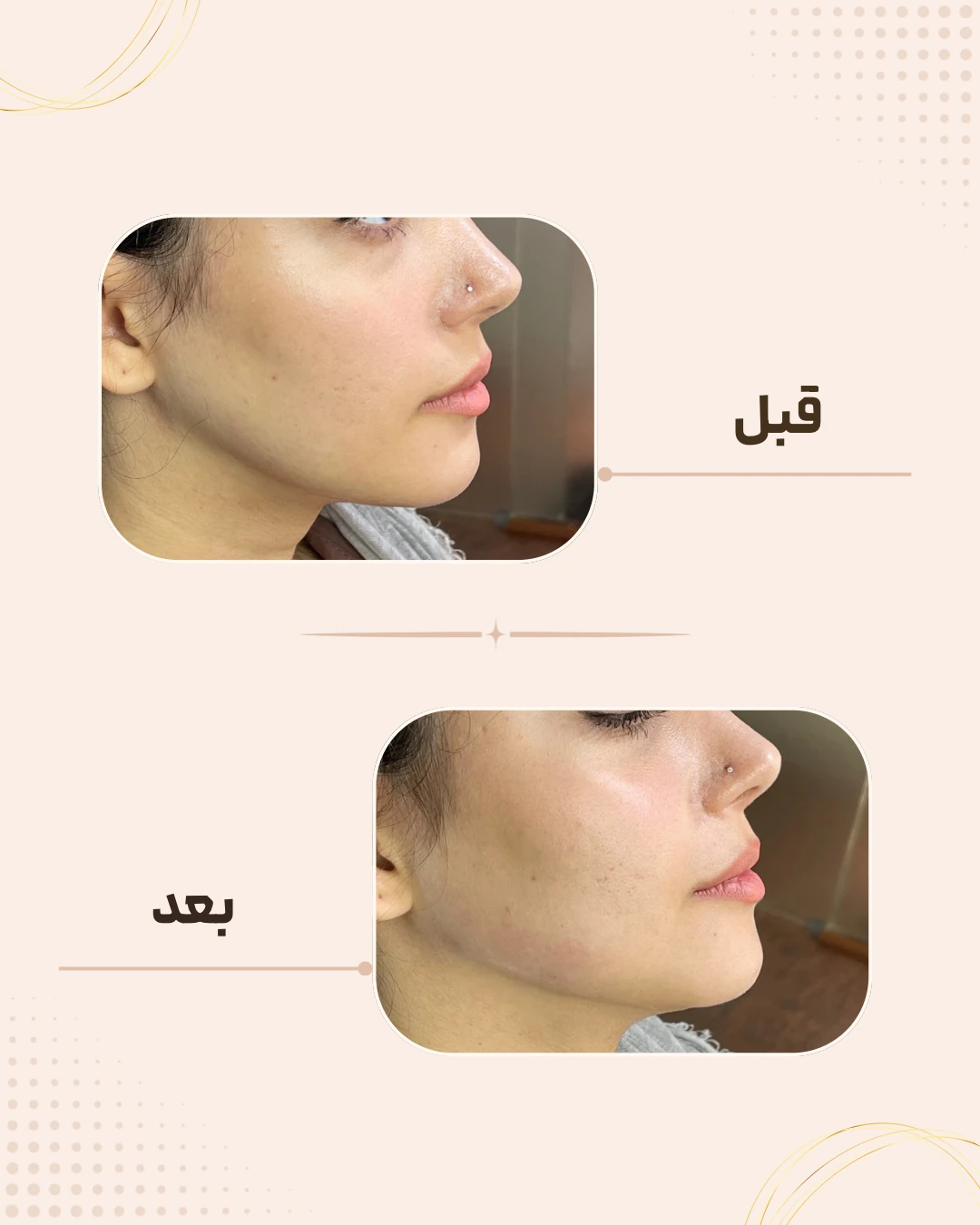 نمونه نتیجه قبل و بعد چانه و زاویه فک در کلینیک زیبایی روناش سقز – شماره 4