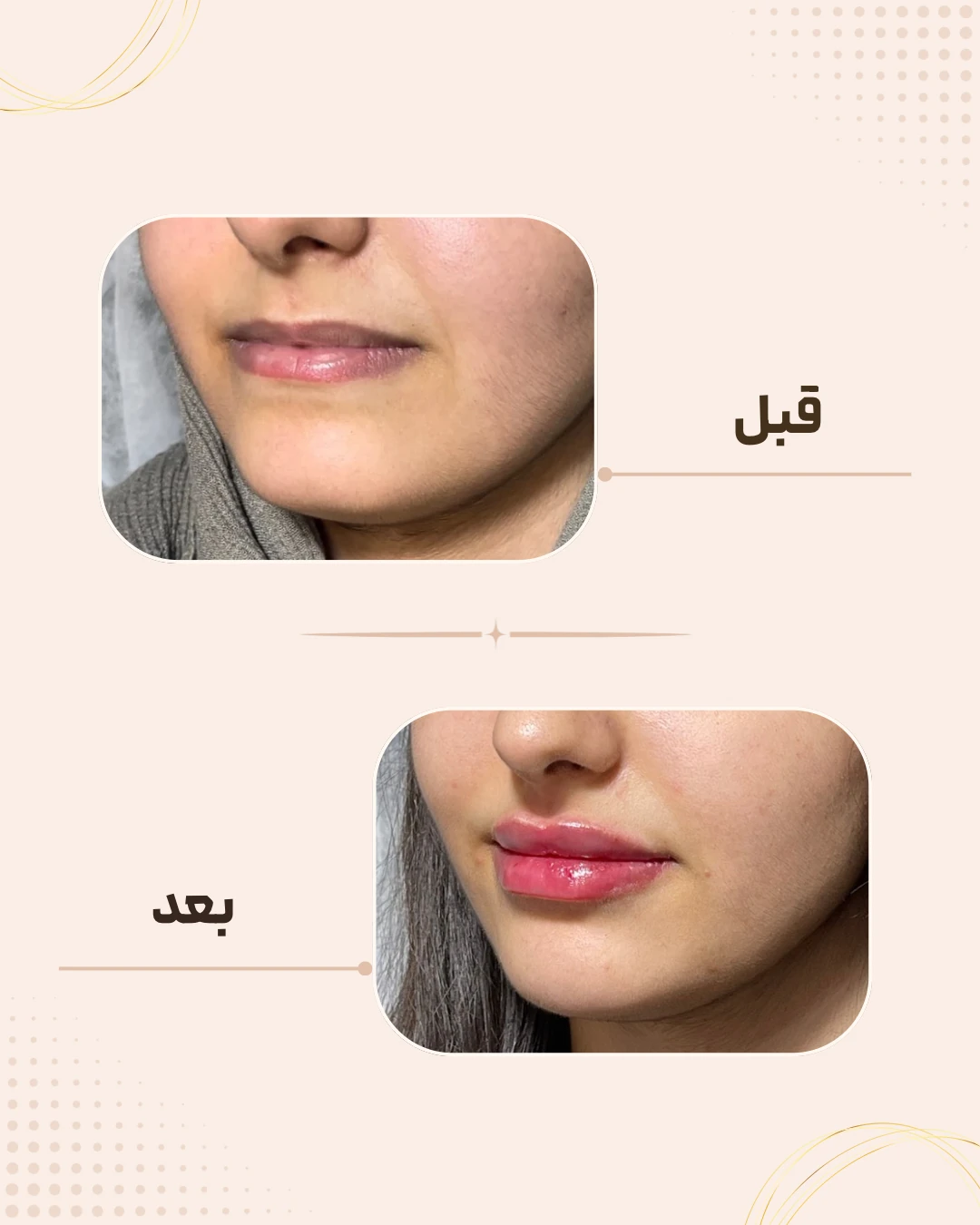 نمونه نتیجه قبل و بعد فیلر لب در کلینیک زیبایی روناش سقز – شماره 8
