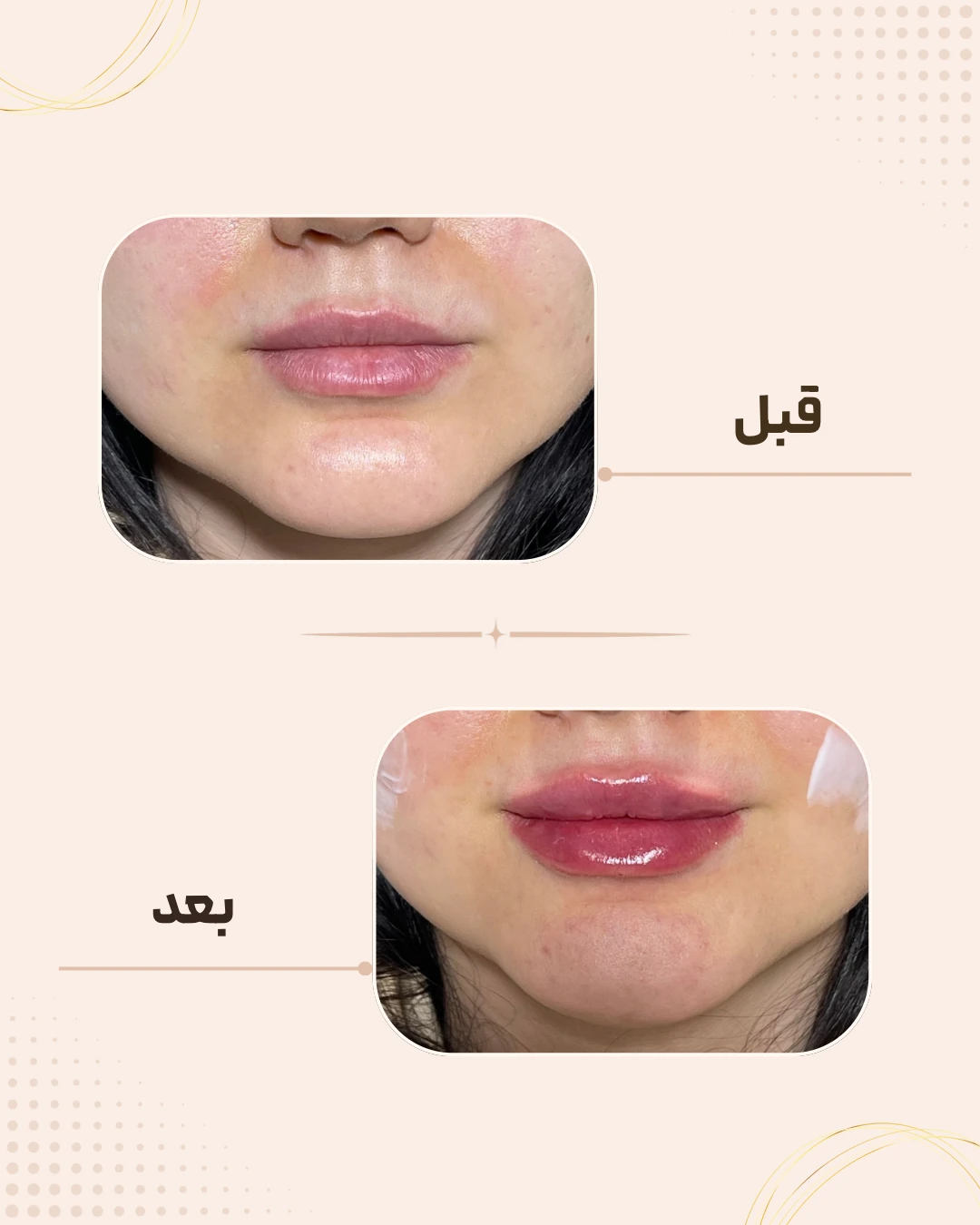 نمونه نتیجه قبل و بعد فیلر لب در کلینیک زیبایی روناش سقز – شماره 9