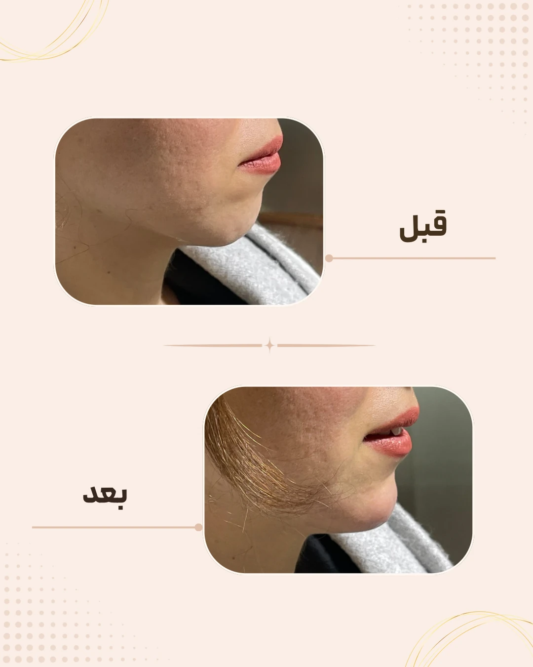 نمونه نتیجه قبل و بعد چانه و زاویه فک در کلینیک زیبایی روناش سقز – شماره 5