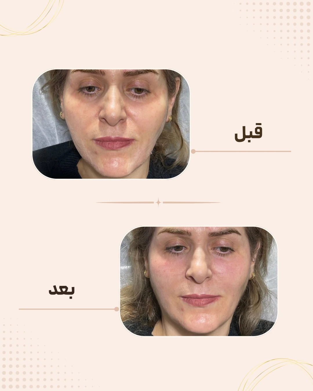 نمونه نتیجه قبل و بعد فیلر خط خنده در کلینیک زیبایی روناش سقز – شماره 3